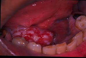 Oral Cancer